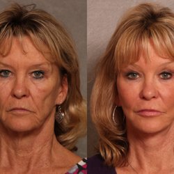 Clinique of Plastic Surgery - Refresher Facelift with Neck Lift, Lower Lid Blepharoplasty, Brow Lift, Fat Transfer to Cheeks, Lips, Nasolabial Folds, & Brow