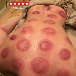 Yudan's Tui Na Therapy Center - Post-massage & cupping session with Yudan!