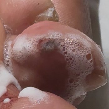 Nail Art Spa - infected Toe - Nail Salons Near Me - Hackensack, New Jersey