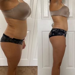 Bare Luxury Body - 1 session of laser cavitation