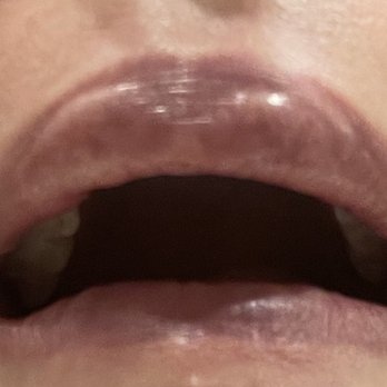 Essensa Clinic - Filler lumps shown again - IV Hydration Near Me - Las Vegas, Nevada Essensa Clinic - Filler lumps shown again - IV Hydration Near Me - Las Vegas, Nevada