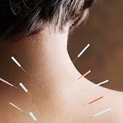 Pom Wellness Center - Acupuncture for neck pain. Acupuncture is proven to help with pain.
