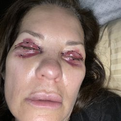 Fante Eye & Face Centre - No bruising here! I was bruised for months.