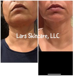 Neckline & jawline non surgical