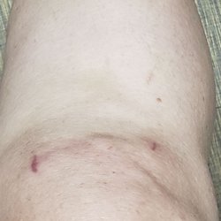 The CORE Institute - West Phoenix - Scars are looking good and very small. Doubt they will be even noticeable as more than a scratch in a year.
