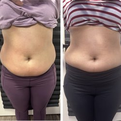 Goddess Body Bar 925 - 4 sessions down. Instant fat removal with zero down time!