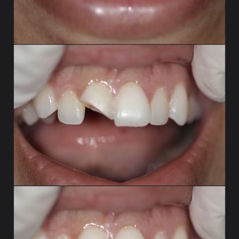 Hobby Dental - The After and Before,
My broken tooth now fixed I love it! - General Dentistry Near Me - Houston, Texas Hobby Dental - The After and Before,
My broken tooth now fixed I love it! - General Dentistry Near Me - Houston, Texas