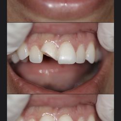 Hobby Dental - The After and Before,
My broken tooth now fixed I love it!