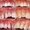 Photo of Periodontitis Treatment B.