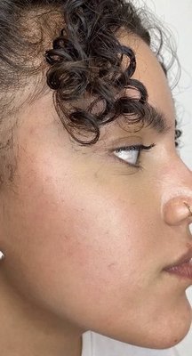Microneedling - Beautiful before and after of this beauty! Microneedling for acne Microneedling - Beautiful before and after of this beauty! Microneedling for acne