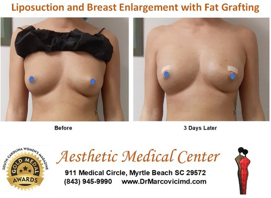 Your own Fat is a great natural filler to enlarge your breasts without the problems related to the breast implants. - Did you know your very own fat can be used as a natural filler to increase the size of an area of concern to you. It can be used for breast enlargements, giving you a natural feel and look, for buttocks enlargement (BBL), for face rejuvenation, for hands rejuvenation, for intimate rejuvenation. As an added bonus because the fat is going to be harvested from an area of concern to you, the end result will be also a sharper body look. All the surgical procedures at Aesthetic Medical Center in Myrtle Beach are done only with Local Tumescent Anesthesia, that is so efficient that there is no need on IV sedation or General Anesthesia. There is minimal or no downtime. To learn more, call our office at 843.945.9990 and visit our website at: www.DrMarcoviciMD.com Your own Fat is a great natural filler to enlarge your breasts without the problems related to the breast implants. - Did you know your very own fat can be used as a natural filler to increase the size of an area of concern to you. It can be used for breast enlargements, giving you a natural feel and look, for buttocks enlargement (BBL), for face rejuvenation, for hands rejuvenation, for intimate rejuvenation. As an added bonus because the fat is going to be harvested from an area of concern to you, the end result will be also a sharper body look. All the surgical procedures at Aesthetic Medical Center in Myrtle Beach are done only with Local Tumescent Anesthesia, that is so efficient that there is no need on IV sedation or General Anesthesia. There is minimal or no downtime. To learn more, call our office at 843.945.9990 and visit our website at: www.DrMarcoviciMD.com
