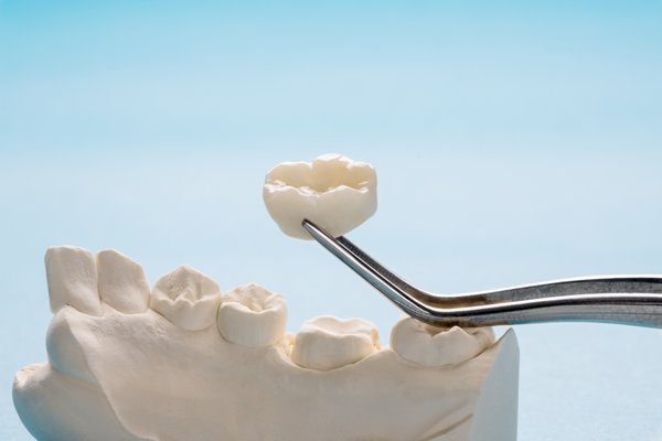 Crowns in One Visit - With CEREC you can have highly aesthetic restorations made in a single visit, without a follow up appointment. Say goodbye to biting on impression material for several minutes and having a numb mouth and jaw ache. A scanner is used to capture your full dentition in seconds and the data is transferred to a computer. The crown is then created as a 3D model on the computer. The restoration is quickly milled from a block of porcelain, directly in the practice. The finished crown is seated in your mouth just a little while later. Crowns in One Visit - With CEREC you can have highly aesthetic restorations made in a single visit, without a follow up appointment. Say goodbye to biting on impression material for several minutes and having a numb mouth and jaw ache. A scanner is used to capture your full dentition in seconds and the data is transferred to a computer. The crown is then created as a 3D model on the computer. The restoration is quickly milled from a block of porcelain, directly in the practice. The finished crown is seated in your mouth just a little while later.