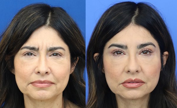 Botox - Botox, improvement of the eyelid region before and after.