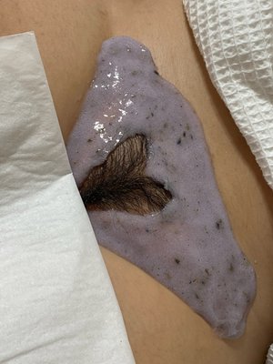 Heart Shaped Brazilian wax - Feeling lovestruck? This is our most popular design offered at skinxeve for those who want to leave a little bit behind. Complete the service with ingrown extractions and a hydrojelly mask for the most luxurious wax service you've ever had.