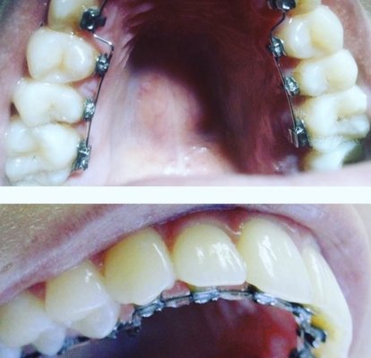 Beautiful smiles with the perfect teeth - Braces are an orthodontic treatment option that can help you achieve a smile that is straighter and healthier. Beautiful smiles with the perfect teeth - Braces are an orthodontic treatment option that can help you achieve a smile that is straighter and healthier.