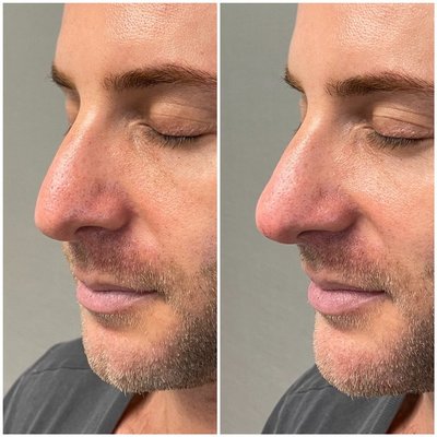 Liquid Rhinoplasty - Liquid Rhinoplasties are advanced procedures that seek to contour the nose without surgery. Liquid Rhinoplasty - Liquid Rhinoplasties are advanced procedures that seek to contour the nose without surgery.