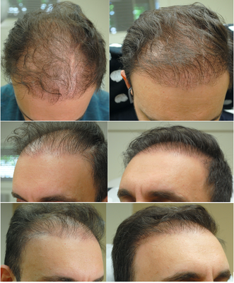 PRP Hair Restoration - Platelet-Rich Plasma (PRP) for Hair Restoration is an evidence-based medical treatment for men and women with hair loss, including androgenic alopecia (hereditary) and telogen effluvium (stress-induced).
A small amount of your blood is drawn and the concentrated plasma with growth-factor-rich platelets used to stimulate the resting follicles to start producing again.
Results vary, and shorter-term hair loss responds more quickly to PRP. Consider this option if you are thinking about hair transplantation or you are undergoing rapid hair loss.
20-minute procedure, minimal pain and no down time. Three treatments over 4 months recommended, plus once yearly for upkeep. PRP Hair Restoration - Platelet-Rich Plasma (PRP) for Hair Restoration is an evidence-based medical treatment for men and women with hair loss, including androgenic alopecia (hereditary) and telogen effluvium (stress-induced).
A small amount of your blood is drawn and the concentrated plasma with growth-factor-rich platelets used to stimulate the resting follicles to start producing again.
Results vary, and shorter-term hair loss responds more quickly to PRP. Consider this option if you are thinking about hair transplantation or you are undergoing rapid hair loss.
20-minute procedure, minimal pain and no down time. Three treatments over 4 months recommended, plus once yearly for upkeep.