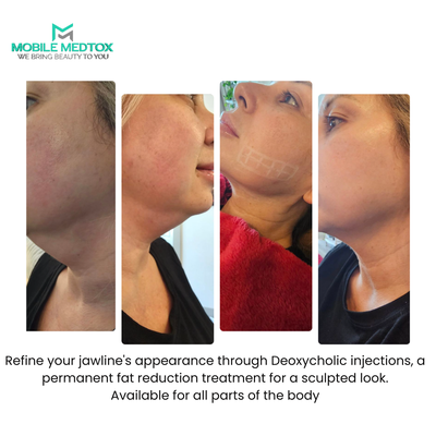 Deoxycholic Acid - Fat Dissolving Treatment - Lipodissolve, or Lipolysis, involves a non-surgical method to minimize stubborn fat cells in multiple areas of the body. The package provides 3 vials, offering extended treatment coverage through multiple sessions or multiple treatment areas. This process' triumph rate is 86%, employing a combination of deoxycholic acid and phosphatidylcholine to remove resilient fat cells after just 2-3 sessions. Most patients have at least 2 -3 treatments spaced two to four weeks apart.