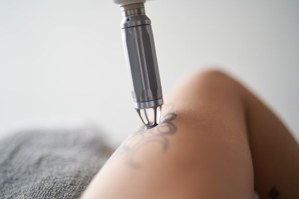 Tattoo Removal - Are you tired of that tattoo that seemed like a good idea at the time, but now just doesn’t fit your style or image anymore? Or perhaps you have a tattoo that has lost its meaning, or you simply want to get it removed to make way for a new one. Whatever the reason, laser tattoo removal can help you say goodbye to your tattoo and hello to a fresh canvas.
Harmony XL Pro laser tattoo removal is the leading technology in the industry, offering fast and effective results with minimal discomfort. But what makes it stand out from other tattoo removal options? Here are just a few of the benefits of choosing Harmony XL Pro for your tattoo removal needs:
Quick and efficient
Harmony XL Pro uses advanced laser technology to break down the ink particles in your tattoo, allowing your body to naturally remove them. Each treatment session only takes a few minutes, and most people need 6-12 sessions to fully remove their tattoo. This means you can say goodbye to your tattoo in a fraction of the time it took to get it in the first place.
Minimal discomfort
While laser tattoo removal may cause some discomfort, the Harmony XL Pro system uses a built-in cooling device to help minimize any discomfort during the treatment. Most people describe the sensation as similar to a rubber band snapping against the skin.
Safe and effective
Harmony XL Pro has been rigorously tested and is backed by decades of research and clinical studies. It is a safe and effective way to remove tattoos, with a high success rate and minimal side effects. No matter your skin tone or type, you can trust that the Harmony XL Pro system will effectively remove your tattoo.
Customizable
The Harmony XL Pro system is highly customizable, allowing the practitioner to tailor the treatment to your specific tattoo and skin type. This ensures that you get the best possible results with minimal risk of side effects. The system is also effective at removing a wide range of tattoo colors, including difficult-to-remove shades like green and yellow. This means you can say goodbye to your tattoo, no matter what colors it may be.
Treatments
Must book a consultation prior to the service. Please numb the area 45 minutes and then again 20 minutes prior to your treatment. Tattoo Removal - Are you tired of that tattoo that seemed like a good idea at the time, but now just doesn’t fit your style or image anymore? Or perhaps you have a tattoo that has lost its meaning, or you simply want to get it removed to make way for a new one. Whatever the reason, laser tattoo removal can help you say goodbye to your tattoo and hello to a fresh canvas.
Harmony XL Pro laser tattoo removal is the leading technology in the industry, offering fast and effective results with minimal discomfort. But what makes it stand out from other tattoo removal options? Here are just a few of the benefits of choosing Harmony XL Pro for your tattoo removal needs:
Quick and efficient
Harmony XL Pro uses advanced laser technology to break down the ink particles in your tattoo, allowing your body to naturally remove them. Each treatment session only takes a few minutes, and most people need 6-12 sessions to fully remove their tattoo. This means you can say goodbye to your tattoo in a fraction of the time it took to get it in the first place.
Minimal discomfort
While laser tattoo removal may cause some discomfort, the Harmony XL Pro system uses a built-in cooling device to help minimize any discomfort during the treatment. Most people describe the sensation as similar to a rubber band snapping against the skin.
Safe and effective
Harmony XL Pro has been rigorously tested and is backed by decades of research and clinical studies. It is a safe and effective way to remove tattoos, with a high success rate and minimal side effects. No matter your skin tone or type, you can trust that the Harmony XL Pro system will effectively remove your tattoo.
Customizable
The Harmony XL Pro system is highly customizable, allowing the practitioner to tailor the treatment to your specific tattoo and skin type. This ensures that you get the best possible results with minimal risk of side effects. The system is also effective at removing a wide range of tattoo colors, including difficult-to-remove shades like green and yellow. This means you can say goodbye to your tattoo, no matter what colors it may be.
Treatments
Must book a consultation prior to the service. Please numb the area 45 minutes and then again 20 minutes prior to your treatment.