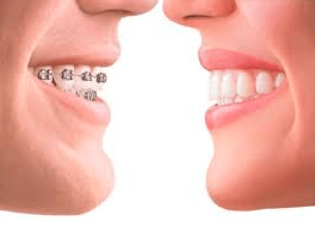 Invisalign - If you want straighter teeth but don’t want to wear traditional braces, Invisalign Clear Aligners are a great option that has been used for years with great success. They are comfortable, near invisible, and allow you to straighten your teeth, fix your bite, and smile with confidence with ease! Invisalign - If you want straighter teeth but don’t want to wear traditional braces, Invisalign Clear Aligners are a great option that has been used for years with great success. They are comfortable, near invisible, and allow you to straighten your teeth, fix your bite, and smile with confidence with ease!