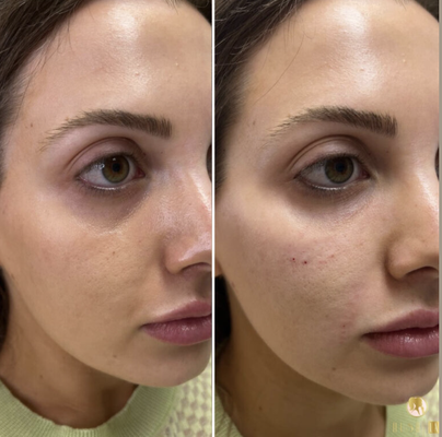 Dermal Fillers - Explore real patient transformations from treatments performed at Hush LA Medspa in Los Angeles. Our gallery features results from dermal fillers. Dermal Fillers - Explore real patient transformations from treatments performed at Hush LA Medspa in Los Angeles. Our gallery features results from dermal fillers.