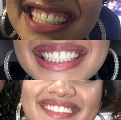 Teeth Whitening - Teeth Whitening results in 1hour. Assisted by a Licensed Dental Hygienist!! Teeth Whitening - Teeth Whitening results in 1hour. Assisted by a Licensed Dental Hygienist!!