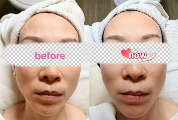 Hydrolifting treatment - The results are real—-and at Cadeau Beauty Spa, the Hydrolifting treatment is where they start. Designed to visibly firm the face and neck, stimulate collagen regeneration, and restore the kind of lifted, sculpted contour that defines a natural V-shape jawline. Fine lines diminish. Skin receives an immediate boost of intensive hydration that leaves it looking radiant and genuinely revitalized. Come in for a consultation at Cadeau Beauty Spa and let the treatment speak for itself.😉 Hydrolifting treatment - The results are real—-and at Cadeau Beauty Spa, the Hydrolifting treatment is where they start. Designed to visibly firm the face and neck, stimulate collagen regeneration, and restore the kind of lifted, sculpted contour that defines a natural V-shape jawline. Fine lines diminish. Skin receives an immediate boost of intensive hydration that leaves it looking radiant and genuinely revitalized. Come in for a consultation at Cadeau Beauty Spa and let the treatment speak for itself.😉