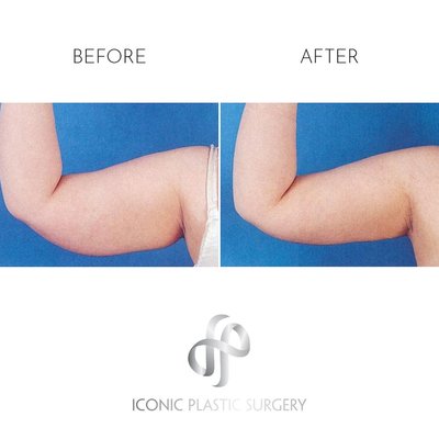 Brachioplasty - The Arm Lift (Brachioplasty) is a surgical procedure aimed at removing excess skin and fat from the upper arms, particularly beneficial for individuals who have experienced significant weight loss or aging. The surgery involves an incision from the underarm to the elbow, allowing for the tightening and smoothing of arm tissue. Recovery typically takes 2-4 weeks, with results visible immediately but final results maturing over several months. Ideal candidates maintain a healthy lifestyle and seek to improve arm contour. Brachioplasty - The Arm Lift (Brachioplasty) is a surgical procedure aimed at removing excess skin and fat from the upper arms, particularly beneficial for individuals who have experienced significant weight loss or aging. The surgery involves an incision from the underarm to the elbow, allowing for the tightening and smoothing of arm tissue. Recovery typically takes 2-4 weeks, with results visible immediately but final results maturing over several months. Ideal candidates maintain a healthy lifestyle and seek to improve arm contour.