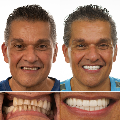 Luis’ Full Mouth Dental Implant Journey - After struggling with severe dental issues for over 20 years, Luis came to Jax Implants looking for a solution. His journey started after losing teeth due to an incident while working in corrections, followed by years of dental work that left him with only a few remaining upper teeth. Now he has full mouth dental implants and is able to eat the foods he loves again without pain or discomfort. His transformation not only restored his smile but also his confidence and quality of life. Luis’ Full Mouth Dental Implant Journey - After struggling with severe dental issues for over 20 years, Luis came to Jax Implants looking for a solution. His journey started after losing teeth due to an incident while working in corrections, followed by years of dental work that left him with only a few remaining upper teeth. Now he has full mouth dental implants and is able to eat the foods he loves again without pain or discomfort. His transformation not only restored his smile but also his confidence and quality of life.