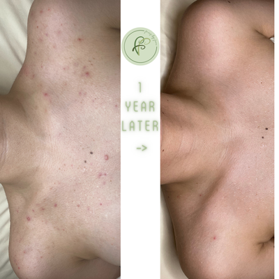 Boot Camp Client E.G. - We could admire these results all day... She has been so consistent with treatments and homecare for over a year now- you can see the change has been REAL! Clear Skin Boot Camp FTW. ​​​​​​​​​Request an appointment if you'd like to get closer to your skin goals, too!