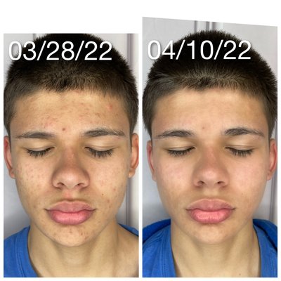 Acne treatments - Book online today:https://www.styleseat.com/m/p/jennifermoreno7
Or give us a call at:9513308069 Acne treatments - Book online today:https://www.styleseat.com/m/p/jennifermoreno7
Or give us a call at:9513308069