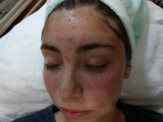 Radian and Young Skin - We provide a very relaxing facials and treatments, helping to improve skin health and customize treatments depends on the client needs. offering from timely express facial to advance facials including Micro needling PRP Vampire facials PRP vitamin facial, PRP BB glow, PRP Botox and filler applied, microdermabrasion, dermaplaning, lifting and tightening facial and peelings. Radian and Young Skin - We provide a very relaxing facials and treatments, helping to improve skin health and customize treatments depends on the client needs. offering from timely express facial to advance facials including Micro needling PRP Vampire facials PRP vitamin facial, PRP BB glow, PRP Botox and filler applied, microdermabrasion, dermaplaning, lifting and tightening facial and peelings.