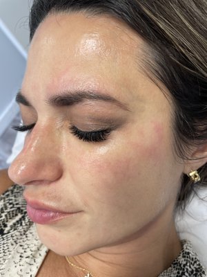 Mezotherapy - Nourish and plump up the skin