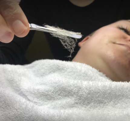 Dermaplaning - Dermaplaning is an exfoliating treatment in which your skincare professional gently removes the outermost layers of your skin with a surgical blade - clearing away dead skin cells and unwanted vellus hairs. The result is renewed skin that appears smoother, brighter and more youthful! Dermaplaning - Dermaplaning is an exfoliating treatment in which your skincare professional gently removes the outermost layers of your skin with a surgical blade - clearing away dead skin cells and unwanted vellus hairs. The result is renewed skin that appears smoother, brighter and more youthful!
