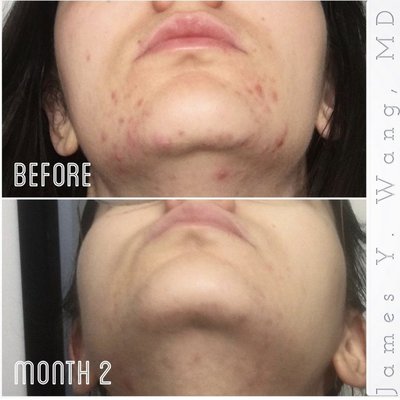 Acne Treatment - We treat acne using facials, personalized skincare, and prescription medications. We then focus on scar treatments over the course of with microneedling and lasers.