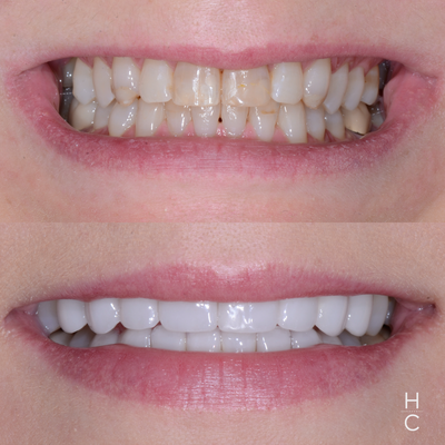 Full Mouth Rehab (FMR) - As the name implies, a full mouth rehabilitation refers to rebuilding and/or replacing of most to all of a patient’s teeth. This treatment combines aesthetic enhancements with restorative dentistry to not only beautify the appearance of the smile, but also, improve the overall health and function of the mouth as well. Chicago Dental Studio specializes in this advanced treatment and has been successfully treating patients in need of a full mouth rehab for over 10 years. Full Mouth Rehab (FMR) - As the name implies, a full mouth rehabilitation refers to rebuilding and/or replacing of most to all of a patient’s teeth. This treatment combines aesthetic enhancements with restorative dentistry to not only beautify the appearance of the smile, but also, improve the overall health and function of the mouth as well. Chicago Dental Studio specializes in this advanced treatment and has been successfully treating patients in need of a full mouth rehab for over 10 years.