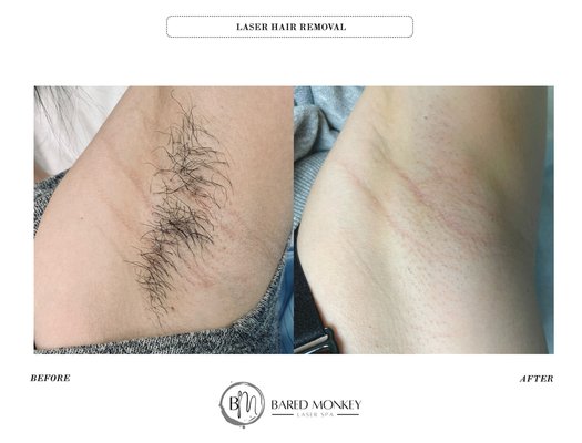 Laser Hair Removal - Over 20 equipment for laser hair removal, we carry equipment from Candela, Alma, Cynosure, Lumenis to deliver the best result in laser hair removal with minimum risk to any skin type. Laser Hair Removal - Over 20 equipment for laser hair removal, we carry equipment from Candela, Alma, Cynosure, Lumenis to deliver the best result in laser hair removal with minimum risk to any skin type.