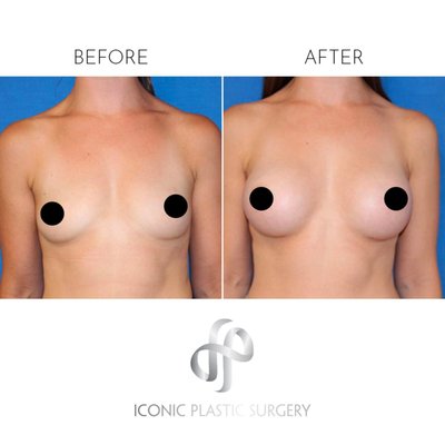 Breast Augmentation - Before and after photos of breast augmentation cases performed by Dr. D'Souza Breast Augmentation - Before and after photos of breast augmentation cases performed by Dr. D'Souza