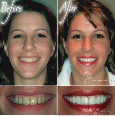 Cosmetic Dentistry Transformations - A Smile Designed by Dr.Elannan at Smile Nuvo Instantly & Dramatically Delivers these Benefits:
🦷 Stains from Teeth Disappear
(Nu Whiter, Brighter Smile)
🦷Gaps & Spaces between Teeth Vanish (Nu Smile Shape)
🦷Patient’s Self Esteem & Self Confidence Sky Rocket (Nu Confidence)
🦷Patients Appear Significantly Younger & Overall More Attractive. Reversing Facial Signs of Aging by Preventing & Diminishing Wrinkles (Nu Beauty)
🦷Optimizes & Restores Oral Health Ultimately Improving Overall Health
(Nu Health)
Nu Smile • Nu YOU Cosmetic Dentistry Transformations - A Smile Designed by Dr.Elannan at Smile Nuvo Instantly & Dramatically Delivers these Benefits:
🦷 Stains from Teeth Disappear
(Nu Whiter, Brighter Smile)
🦷Gaps & Spaces between Teeth Vanish (Nu Smile Shape)
🦷Patient’s Self Esteem & Self Confidence Sky Rocket (Nu Confidence)
🦷Patients Appear Significantly Younger & Overall More Attractive. Reversing Facial Signs of Aging by Preventing & Diminishing Wrinkles (Nu Beauty)
🦷Optimizes & Restores Oral Health Ultimately Improving Overall Health
(Nu Health)
Nu Smile • Nu YOU