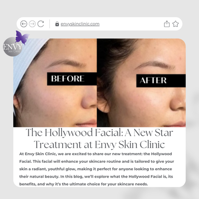 Hollywood Facial - What is the Hollywood Facial?
The Hollywood Facial is a luxurious, non-invasive treatment that combines advanced skincare techniques to rejuvenate your complexion. Inspired by the glamorous beauty routines of Hollywood stars, this facial focuses on deep cleansing, hydration, and revitalization. The facial uses advanced technologies and high-quality ingredients. It provides amazing results without needing invasive procedures.
Key Features of the Hollywood Facial:
Deep Cleansing: The treatment starts with a complete cleanse. This removes dirt and leaves your skin fresh and ready for renewal.
Exfoliation: Gentle exfoliation helps to slough away dead skin cells, revealing a brighter and smoother complexion.
Hydration: Infusion of hydrating serums replenishes moisture, ensuring your skin feels plump and nourished.
Massage Techniques: A relaxing facial massage stimulates circulation and promotes relaxation, enhancing the overall experience.
Customized Treatment: Each Hollywood Facial is tailored to address your specific skin concerns, whether it’s dryness, dullness, or signs of aging. Hollywood Facial - What is the Hollywood Facial?
The Hollywood Facial is a luxurious, non-invasive treatment that combines advanced skincare techniques to rejuvenate your complexion. Inspired by the glamorous beauty routines of Hollywood stars, this facial focuses on deep cleansing, hydration, and revitalization. The facial uses advanced technologies and high-quality ingredients. It provides amazing results without needing invasive procedures.
Key Features of the Hollywood Facial:
Deep Cleansing: The treatment starts with a complete cleanse. This removes dirt and leaves your skin fresh and ready for renewal.
Exfoliation: Gentle exfoliation helps to slough away dead skin cells, revealing a brighter and smoother complexion.
Hydration: Infusion of hydrating serums replenishes moisture, ensuring your skin feels plump and nourished.
Massage Techniques: A relaxing facial massage stimulates circulation and promotes relaxation, enhancing the overall experience.
Customized Treatment: Each Hollywood Facial is tailored to address your specific skin concerns, whether it’s dryness, dullness, or signs of aging.