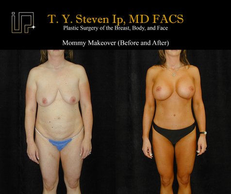 The Ultimate Mommy Makeover by T. Y. Steven Ip, MD - This patient had 4 children and decided to make a big change in her life. She had a mommy makeover by T. Y. Steven Ip, MD and after her surgery began to exercise and watch her diet. She now looks absolutely amazing. The Ultimate Mommy Makeover by T. Y. Steven Ip, MD - This patient had 4 children and decided to make a big change in her life. She had a mommy makeover by T. Y. Steven Ip, MD and after her surgery began to exercise and watch her diet. She now looks absolutely amazing.