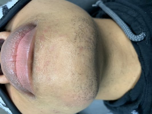 Electrolysis - This electrolysis was done in 30 minutes