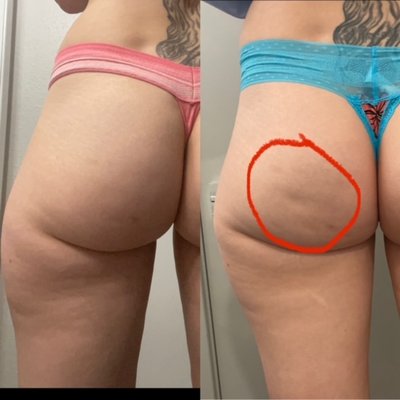 Cavitation (remove fat) laser lipo, skin tightening - I will create a package based on your specific needs including Cavitation to remove the stubborn part, skin tightening, cellulite removal, laser Lipo, and now offering butt cupping Cavitation (remove fat) laser lipo, skin tightening - I will create a package based on your specific needs including Cavitation to remove the stubborn part, skin tightening, cellulite removal, laser Lipo, and now offering butt cupping