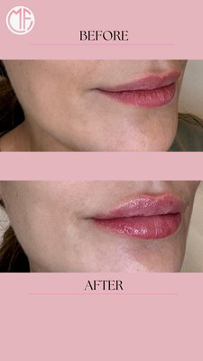 Lip Augmentation - Lip fillers are for you if you’re looking to smooth your lips, correct their shape, or restore plumpness Lip Augmentation - Lip fillers are for you if you’re looking to smooth your lips, correct their shape, or restore plumpness