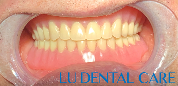 Toothless patients smile restored with dentures set with natural loooking teeth. - Toothless patients smile restored with dentures set with natural loooking teeth. Toothless patients smile restored with dentures set with natural loooking teeth. - Toothless patients smile restored with dentures set with natural loooking teeth.