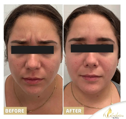 Botox & Dysport Injections - Let's schedule your appointment and get a younger look immediately in professional hands!