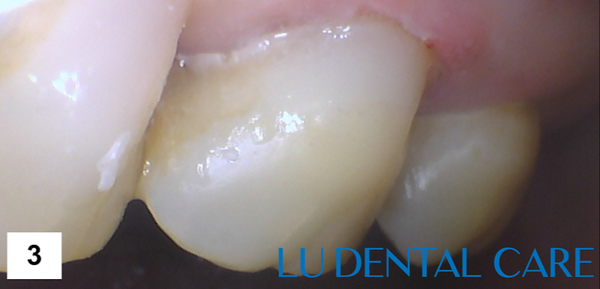 Replacing older generation silver filling with newer generation tooth-colored filling. - Replacing older generation silver filling with newer generation tooth-colored filling. Replacing older generation silver filling with newer generation tooth-colored filling. - Replacing older generation silver filling with newer generation tooth-colored filling.