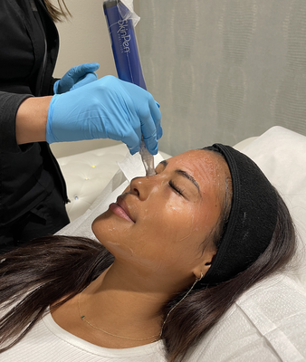 Microneedling - Micropenning (also known as Microneedling, Collagen Inducting Therapy) is an innovative safe skin treatment for all skin types using a micro-needling pen that is used to treat acne scars, surgical scars, stretch marks, pore size, melasma, sun spots, fine and deep lines, and for skin rejuvenation. Microneedling - Micropenning (also known as Microneedling, Collagen Inducting Therapy) is an innovative safe skin treatment for all skin types using a micro-needling pen that is used to treat acne scars, surgical scars, stretch marks, pore size, melasma, sun spots, fine and deep lines, and for skin rejuvenation.