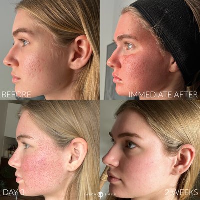 Acne Scar Transformation - My patient has to be in front of the camera for her job and wants to have baby smooth skin without any makeup on. She has been watching our combination treatments for years and finally choose to come see us when we opened our new pop up which allowed more pa tients to be able to boost the confidence and skin across the country.
