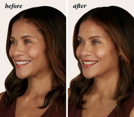 Botox - Are you tired of unwanted wrinkles and frown lines? We want to help you slow the aging process and release your inner beauty. With the experience of Emily Bates and her staff of experienced injectors, your Botox injections will have you looking youthful and reinvigorated. The experienced hands of Emily create beautiful and lasting results. This is not just a treatment for women, Botox for men or Brotox is another one of Emily’s specialities and will make sure you feel comfortable at Bella Grey. Botox - Are you tired of unwanted wrinkles and frown lines? We want to help you slow the aging process and release your inner beauty. With the experience of Emily Bates and her staff of experienced injectors, your Botox injections will have you looking youthful and reinvigorated. The experienced hands of Emily create beautiful and lasting results. This is not just a treatment for women, Botox for men or Brotox is another one of Emily’s specialities and will make sure you feel comfortable at Bella Grey.
